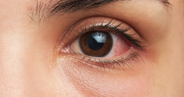 Göz Kızarıklığı Neden Olur? Göz Kızarıklığı Nasıl Geçer?