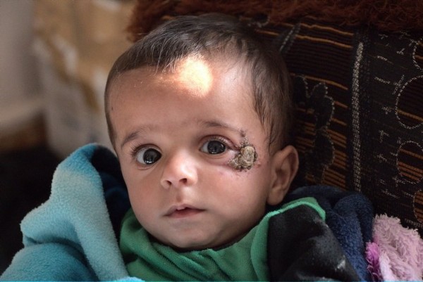 Şark Çıbanı Salgını Nedir? Şark Çıbanı Bulaşıcı Mıdır?