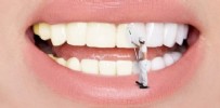 DİŞ TAŞI - Diş Taşlarını Temizlemenin En Etkili Yolları: Evde Diş Taşı Nasıl Temizlenir?