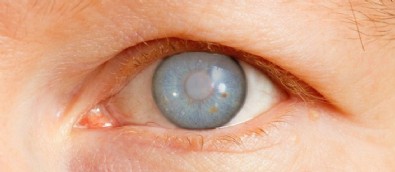 Erken Teşhis Edilmezse Kör Ediyor'! Uzun Süre Bilgisayar Ekranına Bakanlar Dikkat!