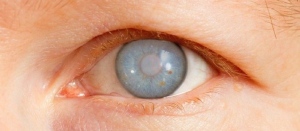 Göz Tansiyonuna Ne İyi Gelir? Erken Teşhis Edilmezse Kör Ediyor'! Uzun Süre Bilgisayar Ekranına Bakanlar Dikkat!