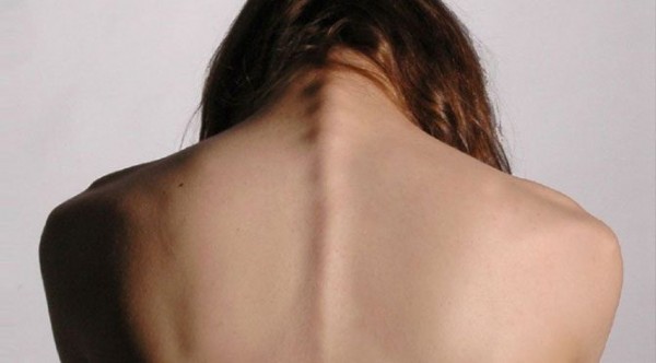 Skolyoz Nedir? Belirtileri Nelerdir?