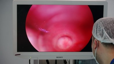 Sancaktepe'de Pektus Farkindalik Haftasina Dikkat Çekmek Için 5 Hasta Ameliyat Edildi