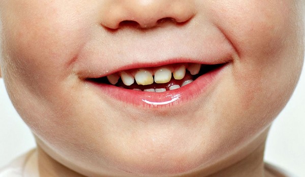 Diş Çürüğüne Ne İyi Gelir? Diş Çürüğü Nasıl Geçer? Diş Çürüğü Nasıl Geçer? Diş Çürümesini Önlemenin Yolları