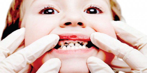 Diş Çürüğüne Ne İyi Gelir? Diş Çürüğü Nasıl Geçer? Diş Çürüğü Nasıl Geçer? Diş Çürümesini Önlemenin Yolları