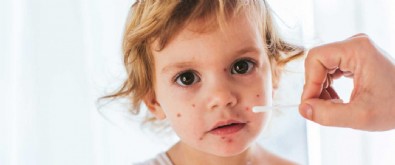 Su Çiçeği Nedir? Belirtileri Nelerdir?