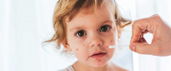 Su Çiçeği Kimler İçin Risklidir? Su Çiçeği Nedir? Belirtileri Nelerdir?