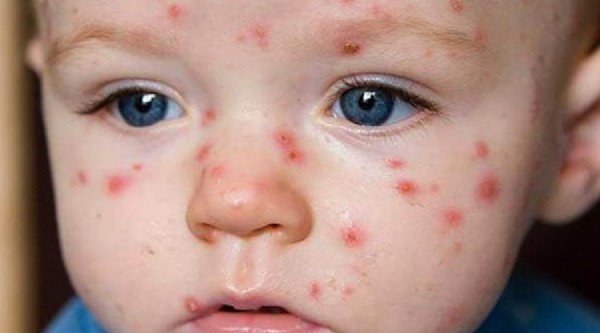 Su Çiçeği Nedir? Belirtileri Nelerdir? Su Çiçeği Nedir? Belirtileri Nelerdir?