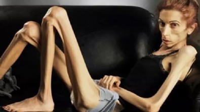 Anoreksiya Nervoza Nedir? Belirtileri Nelerdir?