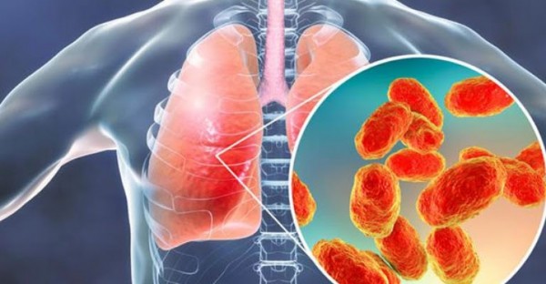 Zatürre Tedavisi Nasıldır? Pnömoni Nedir? Belirtileri Nelerdir?