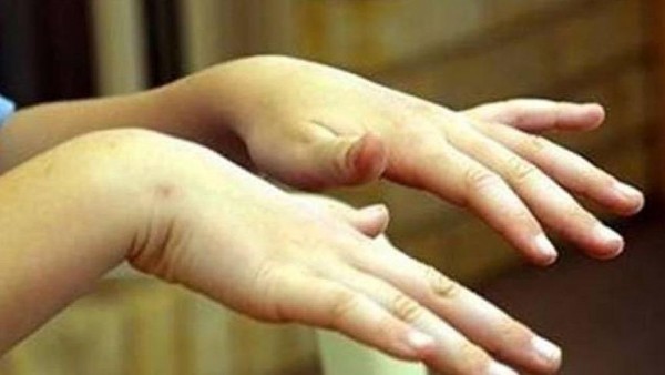 El Titremesi Nedir? El Titremesi Nedenleri Nelerdir?