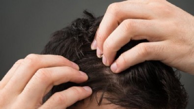 Kelliğe Ne İyi Gelir? Erkeklerde Saç Dökülmesine Doğal Çözümler