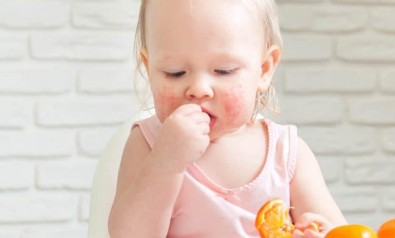 Bebeklerde besin alerjisi belirtileri nelerdir? Bebeklerde alerjiye neden olan besinler nelerdir?
