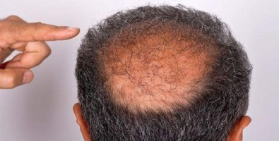 Saç Dökülmesi Tedavisi Nasıldır? Saç Dökülmesi Tedavisi Kimlere Uygulanır?