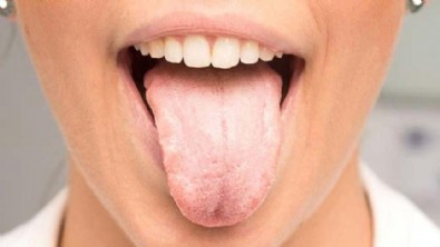 Dil Şişmesi Neden Olur? Dil Şişmesi Nasıl Engellenir?