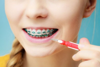 Diş Teli Temizliği Nasıl Yapılır? Diş Teli Nasıl Fırçalanır?