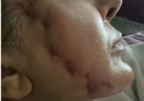 Fransız askısıyla gülüşünü kaybetti! Genç kızın hayatı karardı