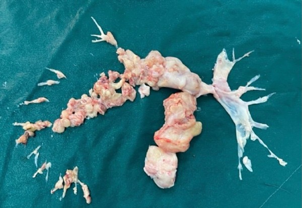 Kovid'e bağlı pıhtı sanıldı ama gerçek kan dondurdu!