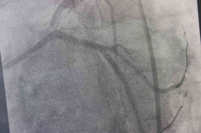 Dünyada Yilda 500 Bin Insanin Ölümü Trans Yaglardan