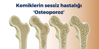 Kemiklerin Sessiz Hastaligi 'Osteoporoz'