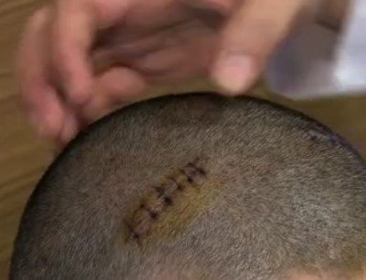 Şifayı Türkiye’de buldu! 12 yıldır ağır depresyon hastasına beyin pili tedavisi .