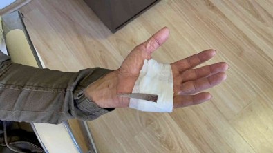 Elinin acısıyla gittiği hastanede çekilen röntgenle hayatının şokunu yaşadı