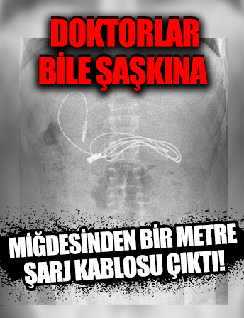 Midesinden bir metre şarj kablosu çıktı: Doktorlar bile şaşkın