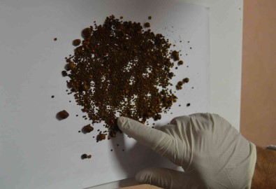 Safra Kesesi Degil Sanki Tas Ocagi Açiklamasi 4 Bin 536 Tas Çikti