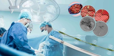 Derin Ven Trombozu Tedavisinde Yeni Dönem Açiklamasi Viper Ultrasonik Farmakomekanik Tromboliz Sistemi