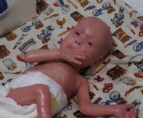  GÖKDENİZ - Yılan bebek Gökdeniz yaşama tutunmaya çalışıyor! Sürekli derisini soymak zorundalar...