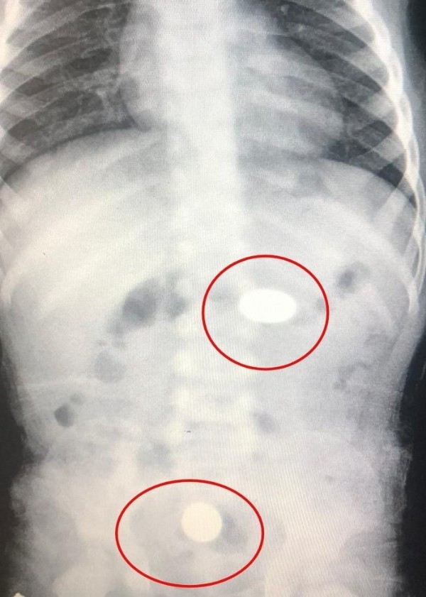 Görenler şaştı kaldı! 2 tane yuttu hastanelik oldu