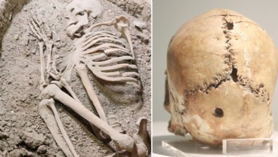 Dünyanın ilk beyin ameliyatı Aksaray’da yapılmış: Görenler inanamadı: 10 bin 500 yıllık!