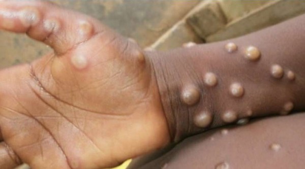 Maymun çiçeği virüsü hızla yayılıyor!