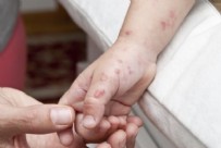 Sağlık Bakanlığı'ndan Maymun Çiçeği açıklaması! Vaka görüldü mü nasıl bulaşıyor?