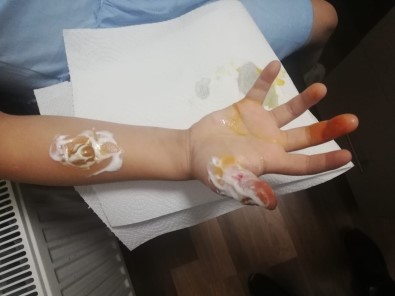 MR Çekilen Küçük Kizin Parmaklari Ve Kolu Yandi