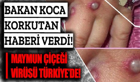 Maymun Çiçeği Hastalığı Türkiye'de görüldü! Bakan Koca'dan açıklama