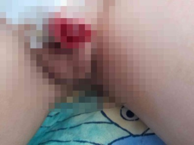 Yanlis Sünnet Edilen Çocugun Hayati Karardi Açiklamasi '21 Gündür Su Içmeye Korkuyor'