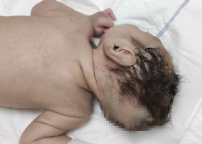 Kahramanmaraş'ta bu bebeği gören şaşırıyor! Beyninin yarısı kafatası dışında doğdu