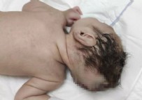 Kahramanmaraş'ta bu bebeği gören şaşırıyor! Beyninin yarısı kafatası dışında doğdu Haberi