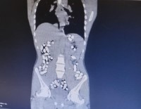 Iran'dan Gelen 5 Kisinin Midesinde 6 Kilo 145 Gram Afyon Sakizi Ele Geçirildi