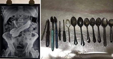 Karnı ağrıyan adamın midesinden 63 kaşık çıktı