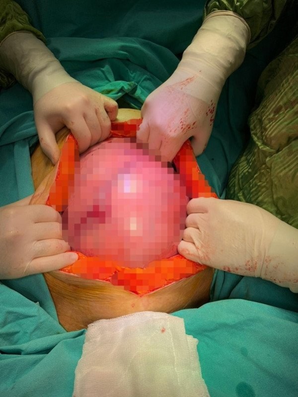 Karnını kaplayan kitle, operasyonla çıkartıldı. Karnından çıkanı görünce gözlerine inanamadı.