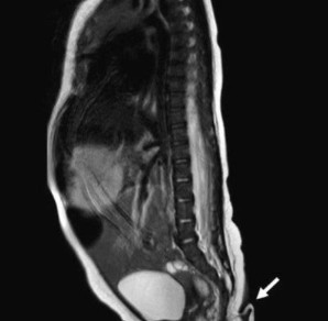 5.7 cm kuyrukla doğdu! Tıp dünyası bu bebeği konuşuyor…