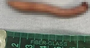 5.7 cm kuyrukla doğdu! Tıp dünyası bu bebeği konuşuyor…