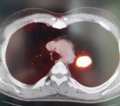 Prof. Dr. Sevket Özkaya Açiklamasi 'Yasayan Her Hücrenin Sonu Kanser'