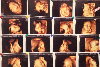 Klinik Olarak Saptanan Gebeliklerin Yüzde 10-15'I Düsükle Sonuçlanmakta