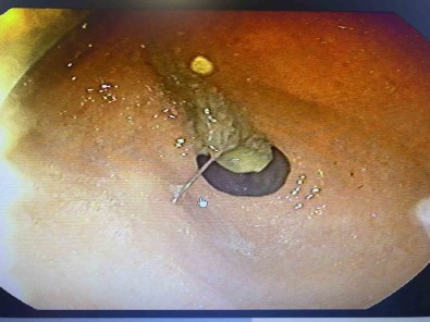 Basörtüsünü Baglarken Hapsirinca Agzina Aldigi Igneyi Yuttu