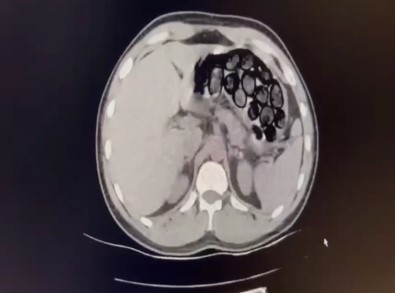 Mide Ve Bagirsagindan 65 Kapsül Uyusturucu Çikti