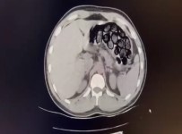 Mide Ve Bagirsagindan 65 Kapsül Uyusturucu Çikti