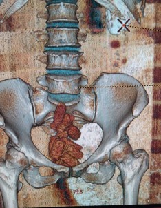 Uyusturucu Maddeyi Bagirsaklarinda Saklamislar